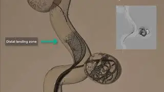 SILK FLOW DIVERTER DEPLOYMENT