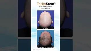 Other ACell+PRP Vs. TrichoStem Hair Regeneration: Cost, and Treatment Frequency #hairloss