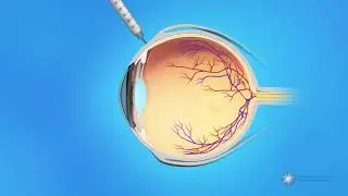 How are eye injections done?