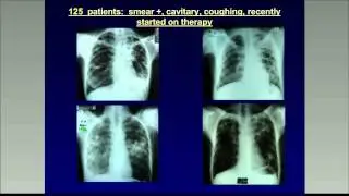 Basics of transmission control in an era of MDR-TB treatment
