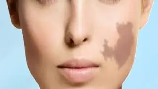 how to get rid of birthmarks on skin
