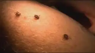 Potentially deadly tick borne virus moving Should you be concerned