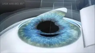 Microkeratome