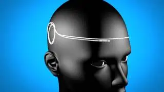The Reed Procedure for Migraine & Headache Treatment Dallas Pain Specialist Dr. Ken Reed