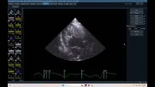 IQ 697 LV GWE MYOCARDIAL WORK EFFICINCY LVEF LVGLS LVTTP LVPSD ECHOCARDIOGRAPHY