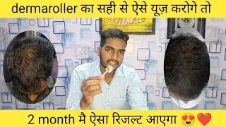 Dermaroller | uses | precaution | dermaroller ko kese use krte hai | result kitne time mai milega 