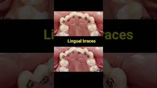 Lingual Braces Transformation #braces #orthodontist #dentist #dental