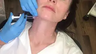 Profhilo Neck. Transform Your Neck with Profhilo: Expert Treatment by Sharon at Mi Skin Clinic!