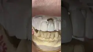 Central Incisor Implant #lsk121shorts #teeth #dental