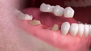 Diş K&ouml;pr&uuml;s&uuml; Nasıl Yapılır?