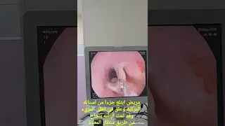 #foreignbody #esophagus #endoscopy #gastroscopy #gastroenterology #gastroenterologist #funnymedia