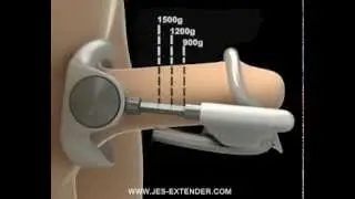 Jes-Extender - Penis Enlargement For Everyone - Male Enhancement Device