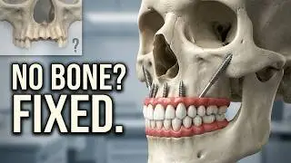 👉 No Bone? No Problem! Zygomatic Implants - The Last Hope for a Perfect Smile
