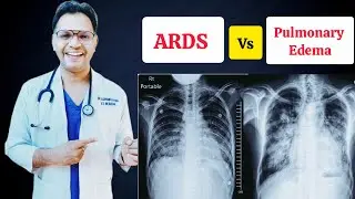 ARDS vs cardiogenic pulmonary Edema #ards #chestxray