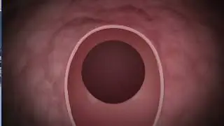 Enucleaci&oacute;n Prost&aacute;tica con L&aacute;ser Mium | Tratamiento de Hiperplasia Benigna en Urocat Barcelona