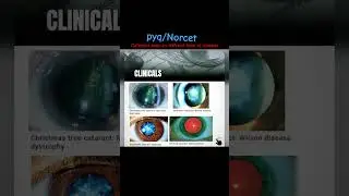 Cataract seen diffrent disease//#norcet #pyq#nursingofficer #trend #shorts #reels #kgmu #sgpgi #yt