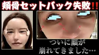 頬骨セットバック失敗して顔ぼこぼこになった😇