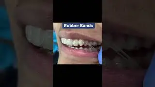 Invisalign Rubber Bands