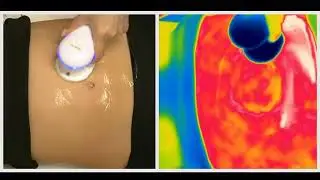 Jacksonville Cellulite Treatment | TempSure Firm Even Heating Treatment