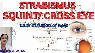 Strabismus/ Squint/ Cross eyes- lack of fusion of eyes; types of Strabismus