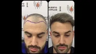 Injerto antes y después. Cirugía de Restauración de 1ª Línea Frontal Completa