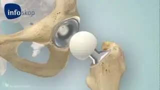 Totalendoprothese am H&uuml;ftgelenk, schematische Darstellung