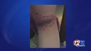 5 Year Old Got Bit By Black Widow Spider