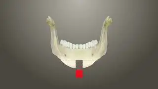 V-line Surgery