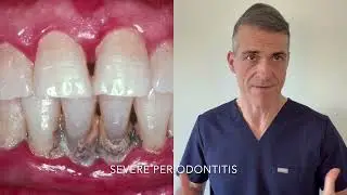 Why GUM disease (Periodontitis) causes receding gums?