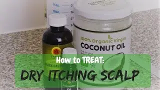 DIY REMEDY TO TREAT DANDRUFF AND DRY ITCHY SCALP | KIESHA ARIELLE