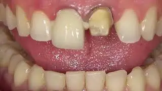 How to use Coltene SoloCem