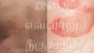 #🙄சொரி, சிரங்கு,கட்டி வருவதற்கான காரணங்கள் என்ன🙄?#human body full details|
