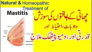 Mastitis Natural & Homeopathic Treatment || Chati k Bafton ki Sozish ka Qudrati aur Homeopathic Elaj