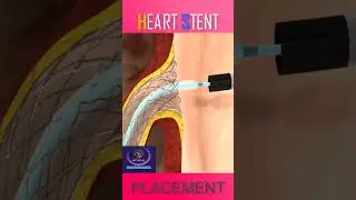 Heart Stent Placement #shorts