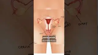 2 Types of Painful Periods 🩸 Primary Dysmenorrhoea & Secondary Dysmenorrhea #periods