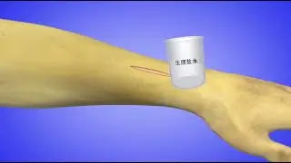 三维清创术演示动画