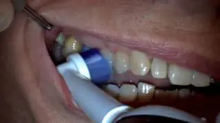Dental patient education video: Electric brush instructions for a patient