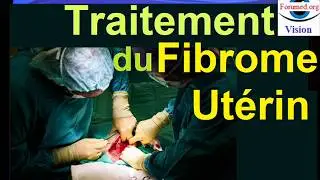 Traitements du Fibromes utérins