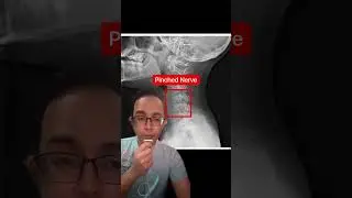 Pinched nerve?