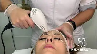 Tratamiento de Radiofrecuencia Facial VIORA