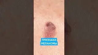 Меланома кожи 📌 симптомы, признаки, фото как выглядит рак кожи