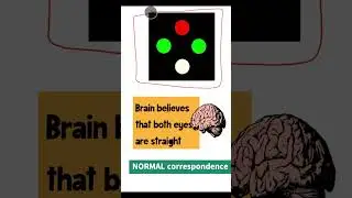 Normal retinal correspondence( NRC)
