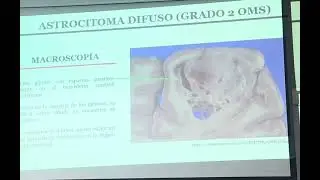 Patolog&iacute;a 15 diciembre astrocitoma - gioblastoma