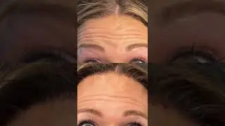 Thread Lift on the forehead PDO thread lift 