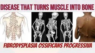 Disease that turns muscle into bone || FIBRODYSPLASIA OSSIFICANS || explained in detail 