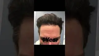 1 Year Neograft Hair Transplant Before and After Pictures | Dr Jeneby