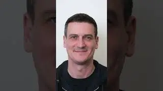 Hair Transplant at 5 Months: Johnny&rsquo;s Real Results & Experience | Este Medical Group