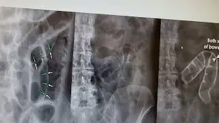 Rigler sign ,pneumoperitoneum, double wall sign