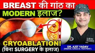 स्तन की गांठ का इलाज बिना Surgery | Breast Lump Treatment Without Surgery | Cryoablation