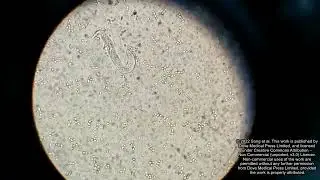 Misdiagnosed disseminated strongyloidiasis case - Supplementary video 1 [ID 381298]